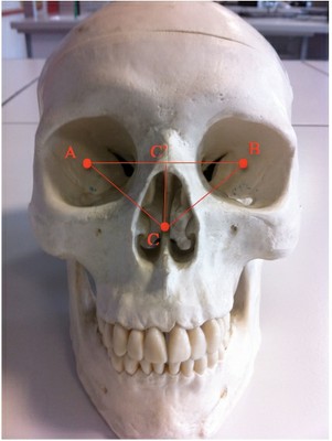 orbitonasal